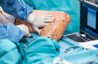 Chirurgien réalisant une procédure de stripping de la varice sur une jambe, avec des incisions marquées et une sonde insérée dans la veine malade, en salle d'opération